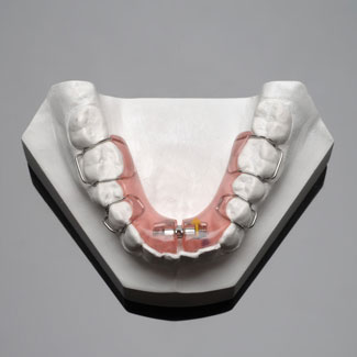 Removable Expander Appliance - Lower Arch